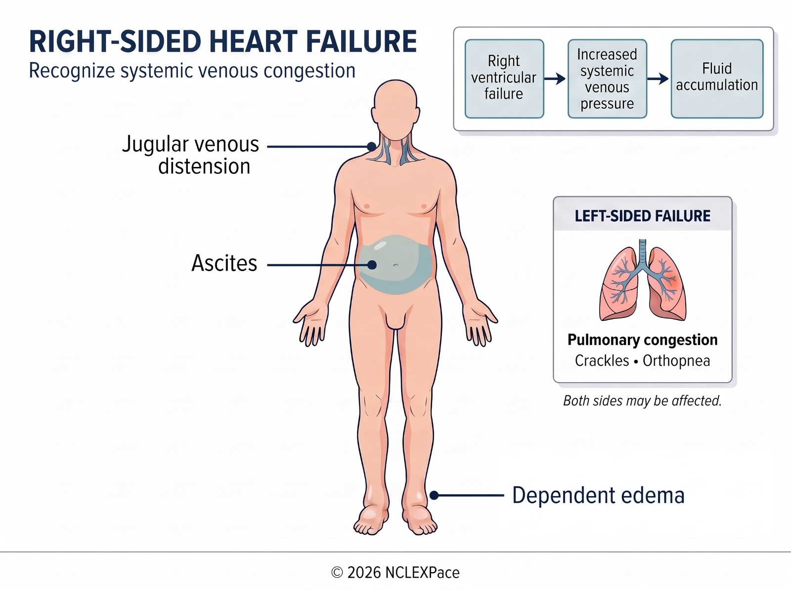 Right-sided heart failure: jugular venous distension, ascites and dependent edema from systemic venous congestion, with an inset showing left-sided failure as pulmonary congestion with crackles and orthopnea