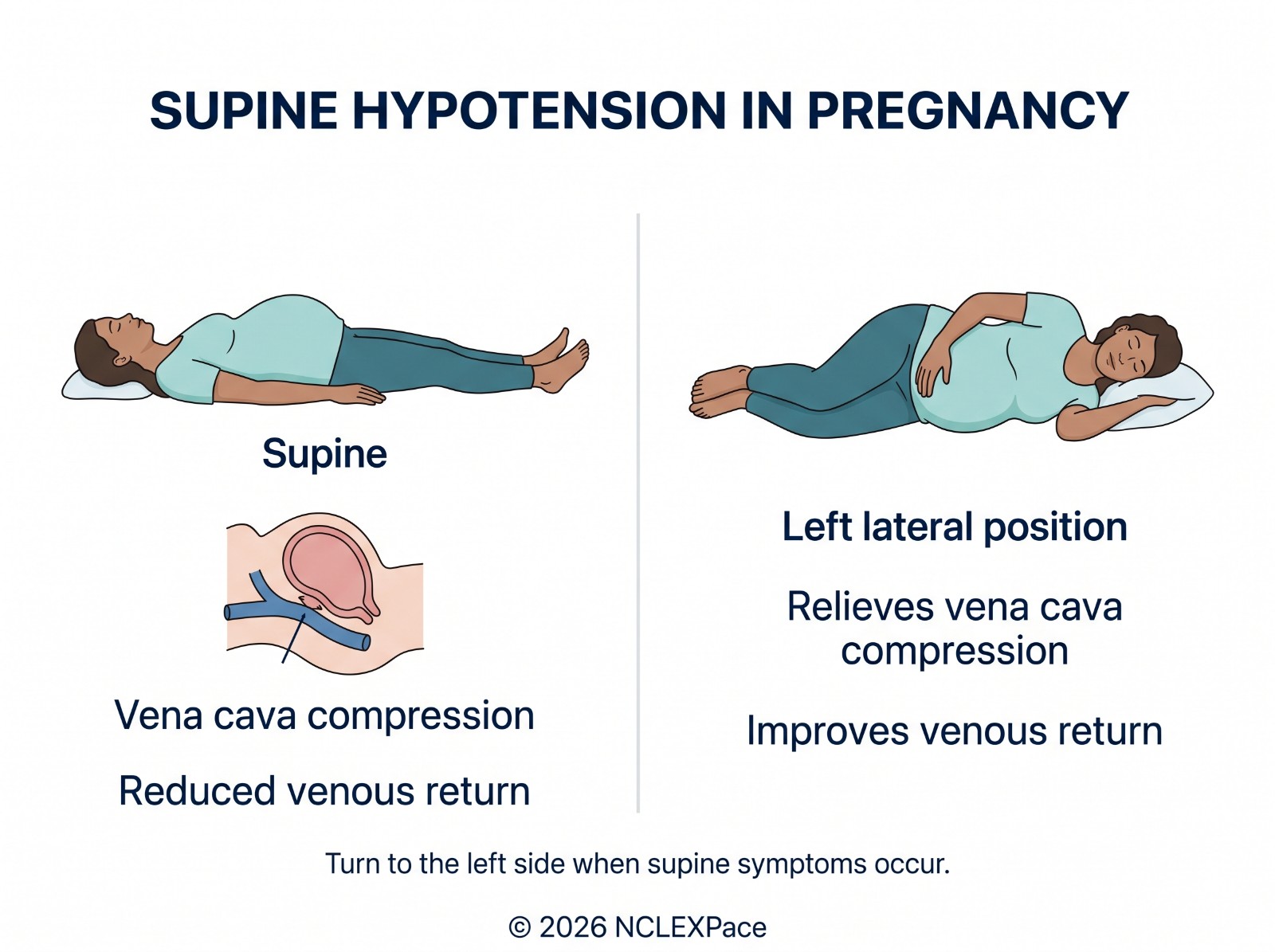 Supine hypotension in pregnancy: lying flat compresses the vena cava and reduces venous return; the left lateral position relieves it