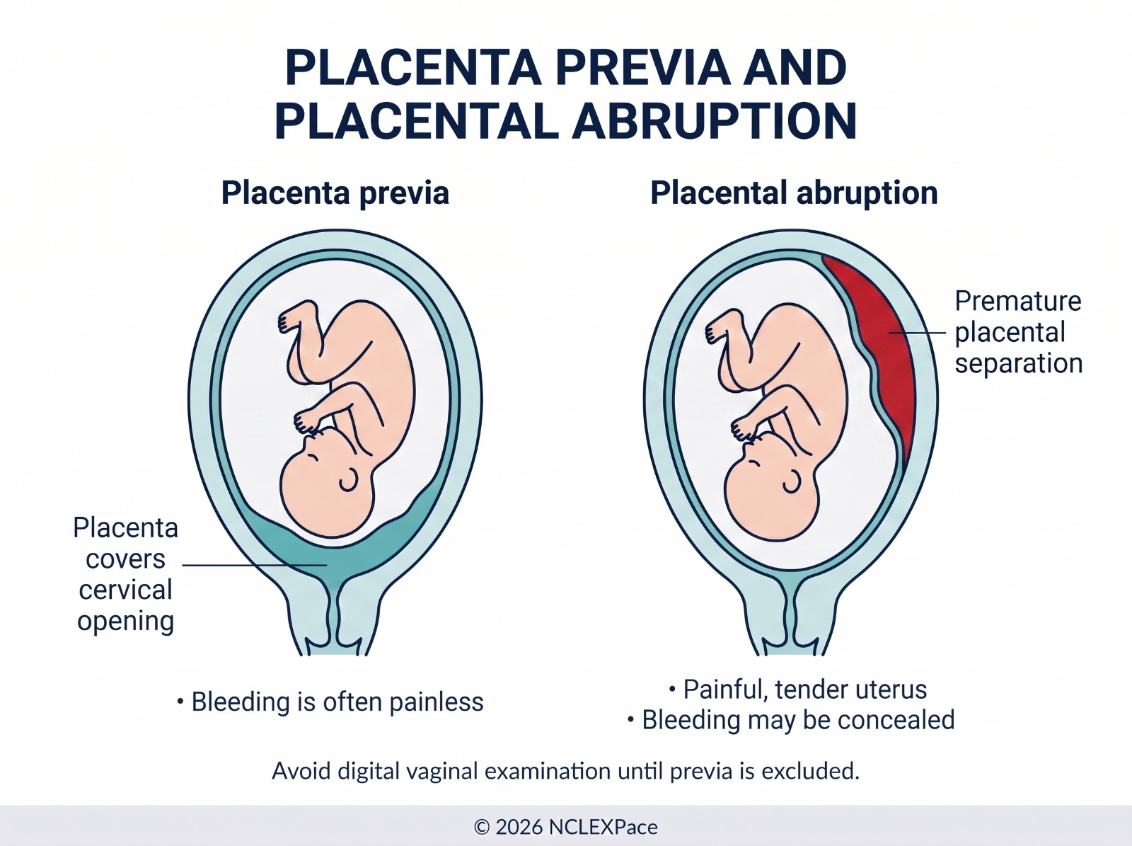 Placenta previa, where the placenta covers the cervical opening and bleeding is often painless, compared with placental abruption, where the placenta separates early and the uterus is painful and tender