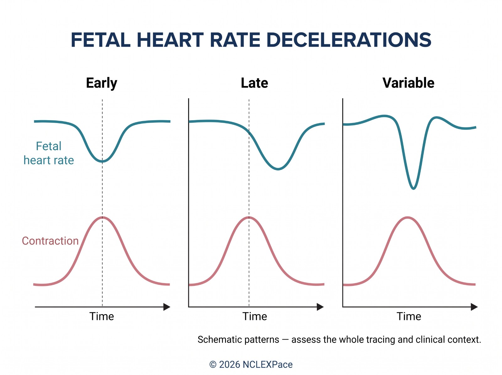 Fetal heart rate decelerations compared with the contraction curve: early decelerations mirror the contraction, late decelerations begin after its peak, variable decelerations are abrupt and unrelated to it