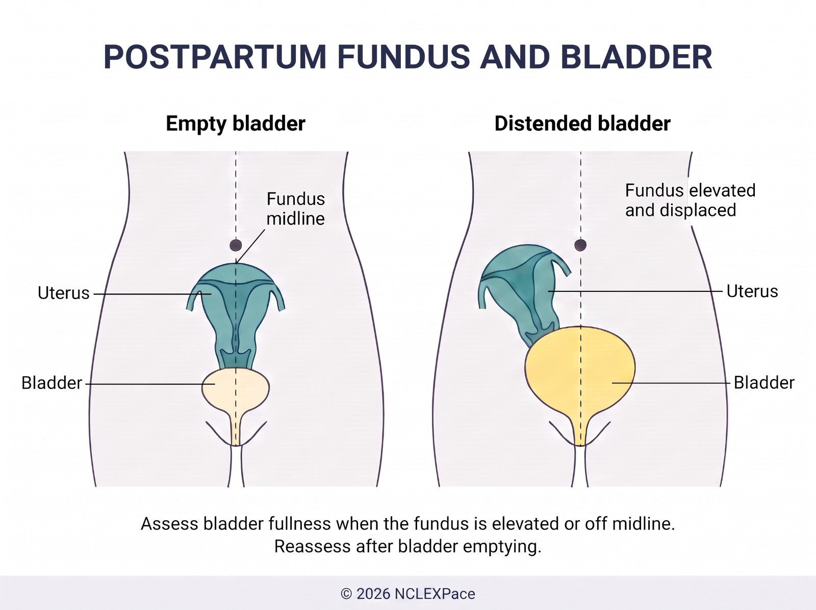 Postpartum fundus with an empty bladder, midline and firm, compared with a distended bladder that pushes the fundus up and off to the side