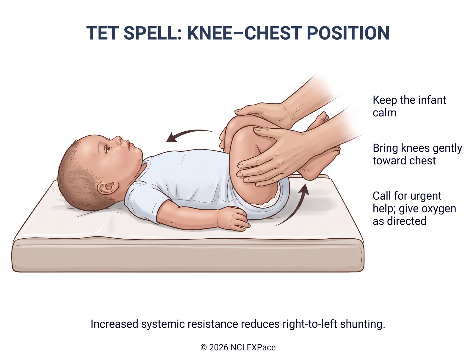 Tet spell knee-chest position: the infant is held calm with the knees brought gently toward the chest while oxygen is given