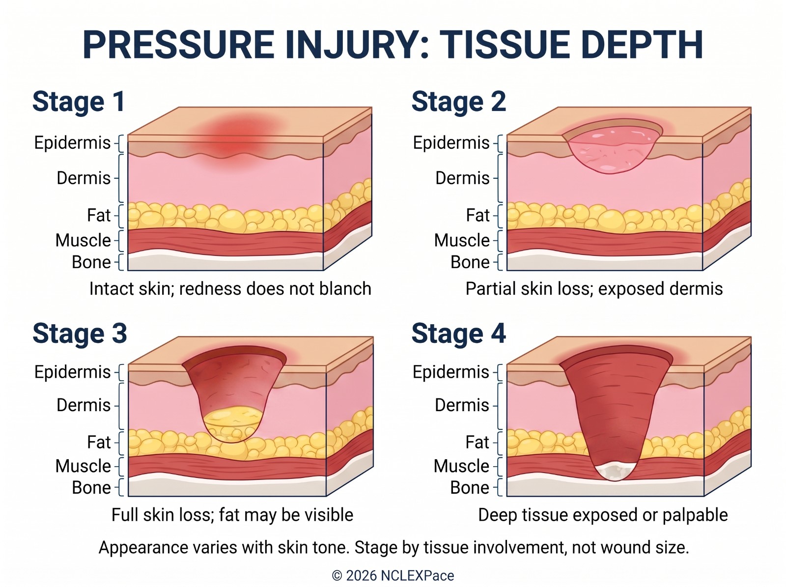 Pressure injury by tissue depth: stage 1 intact skin with non-blanching redness, stage 2 partial skin loss with exposed dermis, stage 3 full skin loss with fat visible, stage 4 deep tissue exposed or palpable