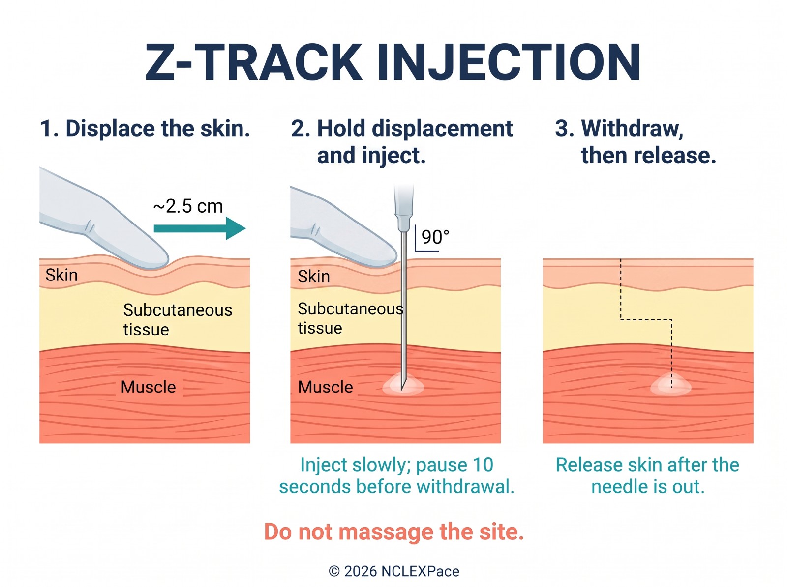 Z-track intramuscular injection: the skin is pulled to the side before the needle goes in and released after, sealing the medication in the muscle