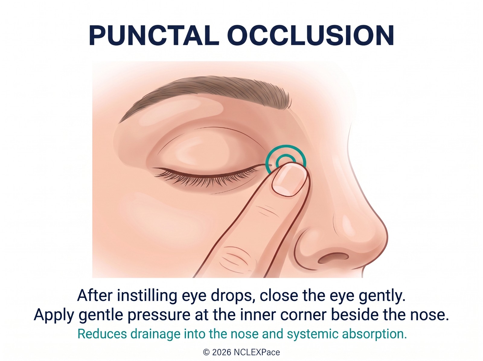 Punctal occlusion after eye drops: gentle pressure on the inner corner of the eye keeps the drop in the eye and out of the tear duct