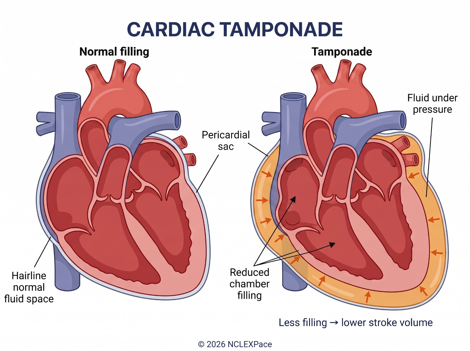 Cardiac tamponade compared with normal filling: fluid under pressure in the pericardial sac compresses the heart and reduces chamber filling and stroke volume