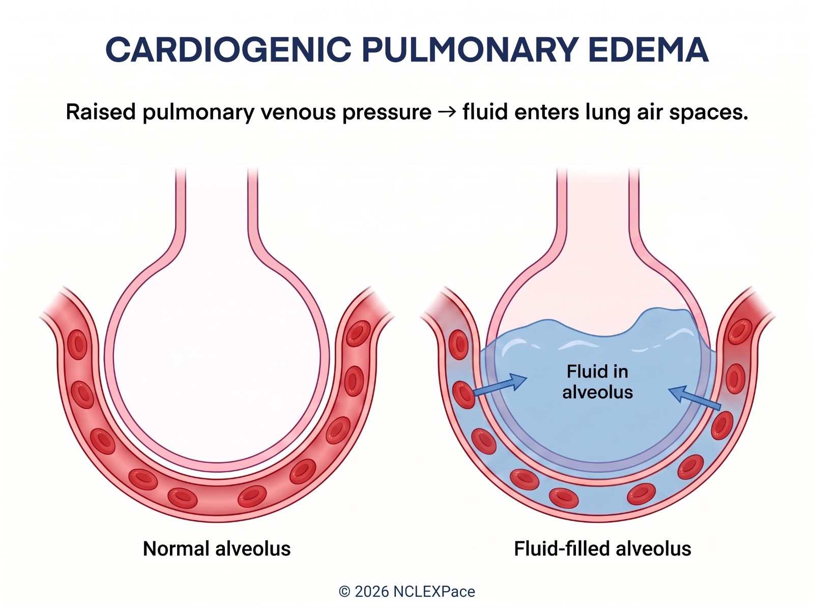 Cardiogenic pulmonary edema: raised pulmonary venous pressure pushes fluid from the capillaries into the alveolus, shown as a normal alveolus next to a fluid-filled one