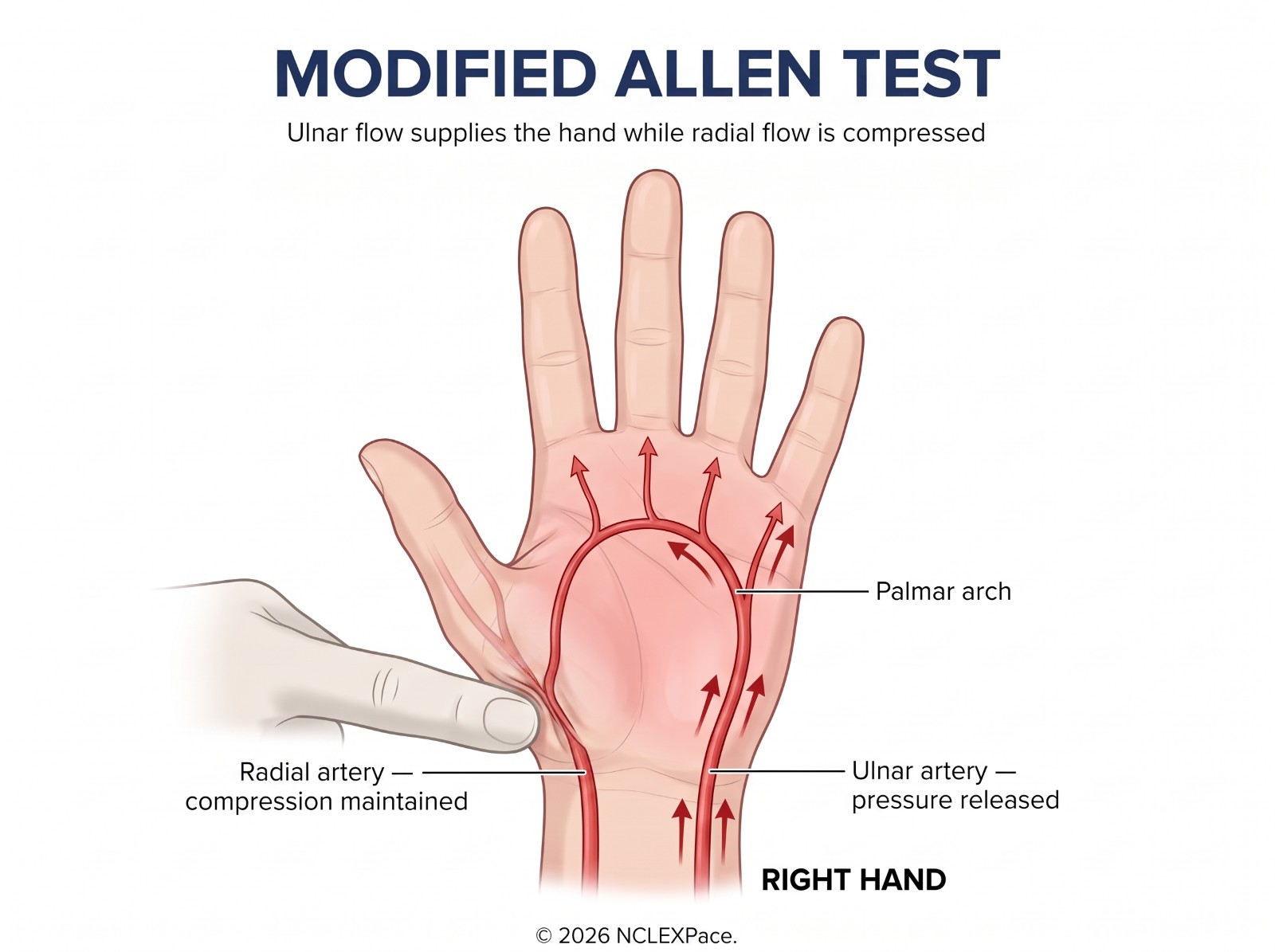 Modified Allen test: the radial artery is compressed while the ulnar artery is released, showing that ulnar flow alone supplies the hand through the palmar arch