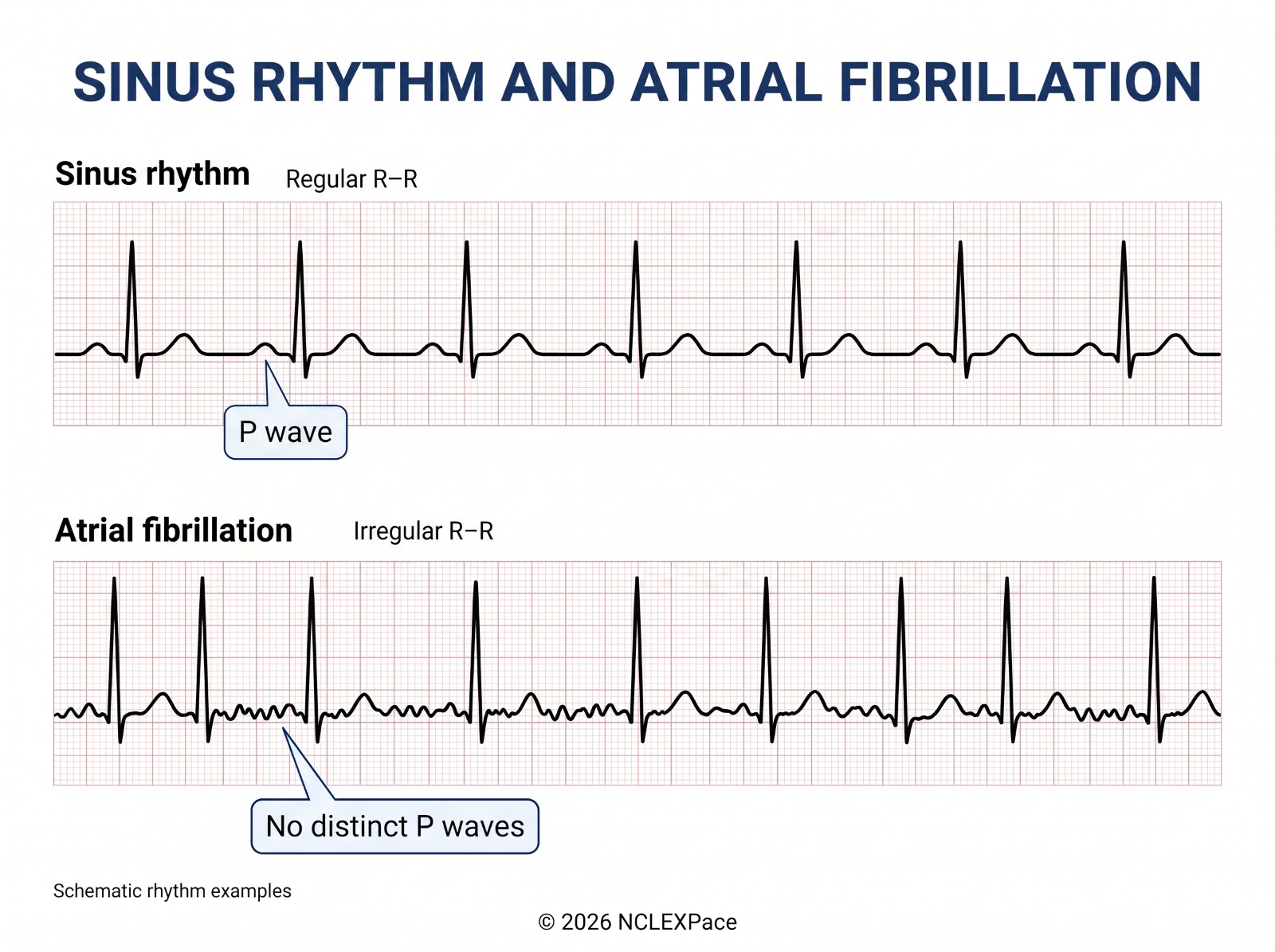 Sinus rhythm with regular R-R intervals and P waves compared with atrial fibrillation, which has irregular R-R intervals and no distinct P waves