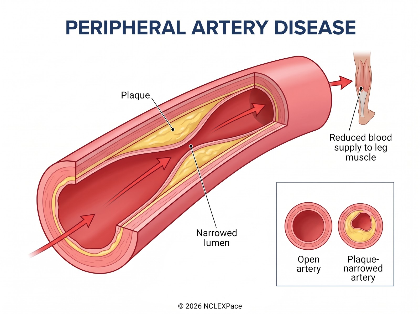Peripheral artery disease: plaque narrowing an artery and reducing blood supply to the leg muscle, with an open artery compared to a plaque-narrowed one