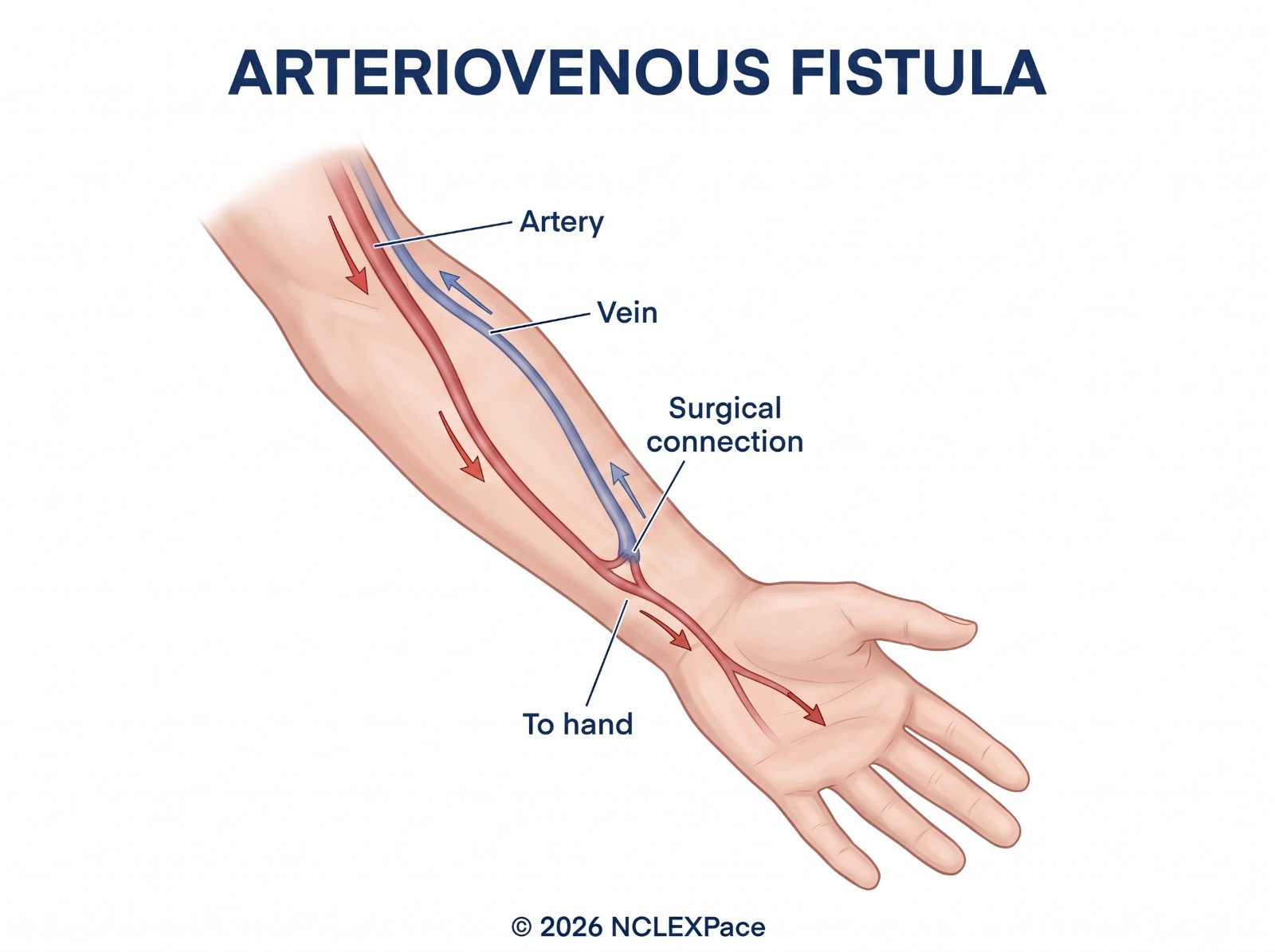 Arteriovenous fistula in the forearm: a surgical connection joins an artery to a vein so the vein enlarges for dialysis access