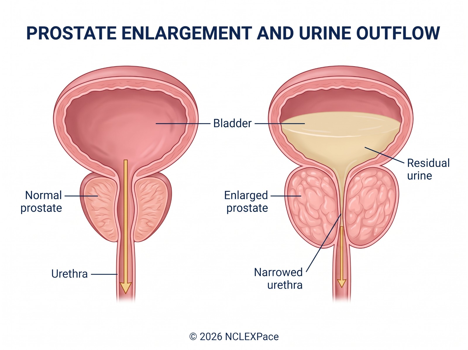 Prostate enlargement narrowing the urethra and leaving residual urine in the bladder, compared with a normal prostate