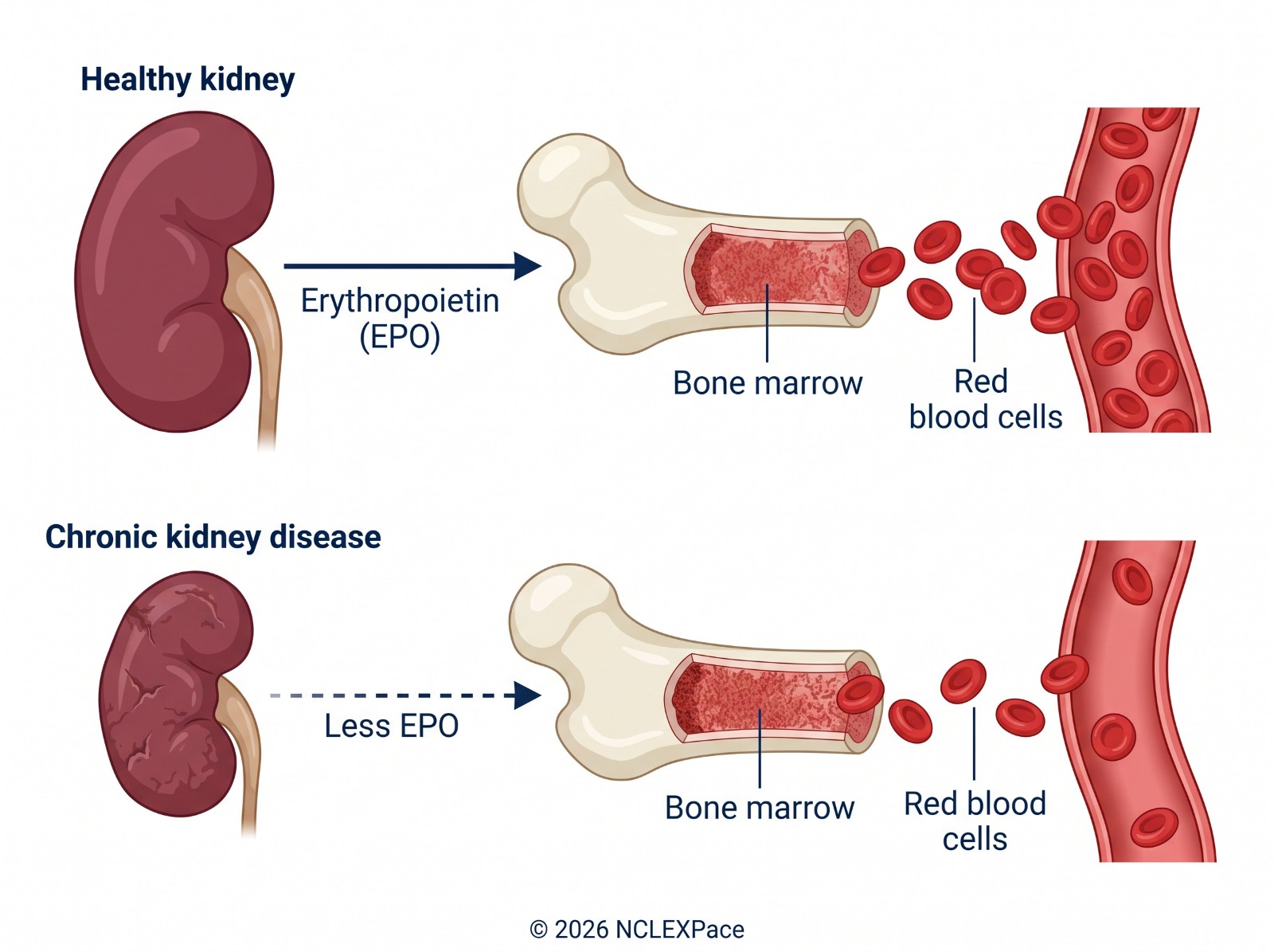 A healthy kidney releases erythropoietin so bone marrow makes red blood cells; in chronic kidney disease less erythropoietin means fewer red blood cells