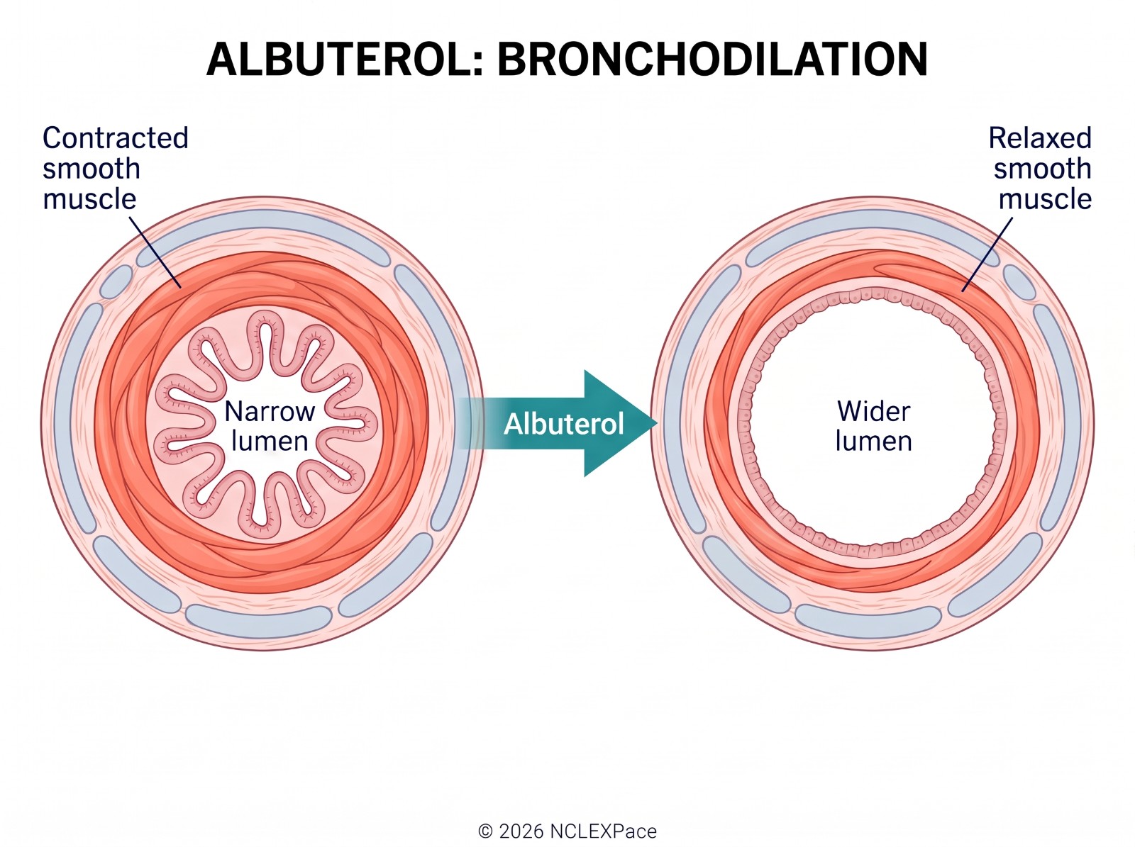 Albuterol relaxes contracted bronchial smooth muscle, turning a narrow airway lumen into a wider one