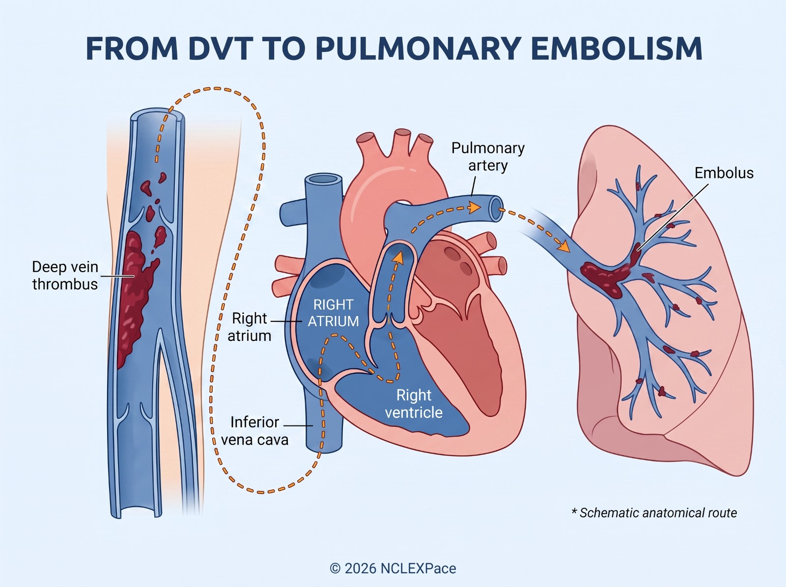 A deep vein thrombus in the leg travels through the inferior vena cava and right heart into the pulmonary artery, where it lodges as a pulmonary embolus