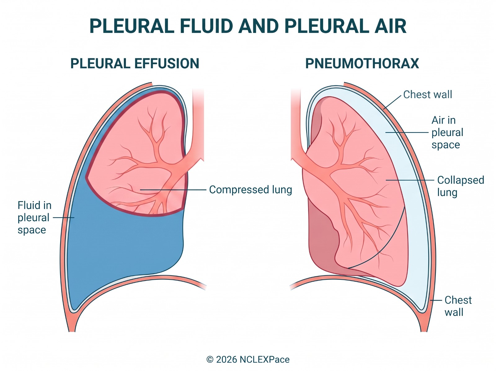 Pleural effusion with fluid in the pleural space compressing the lung, next to a pneumothorax with air in the pleural space and a collapsed lung