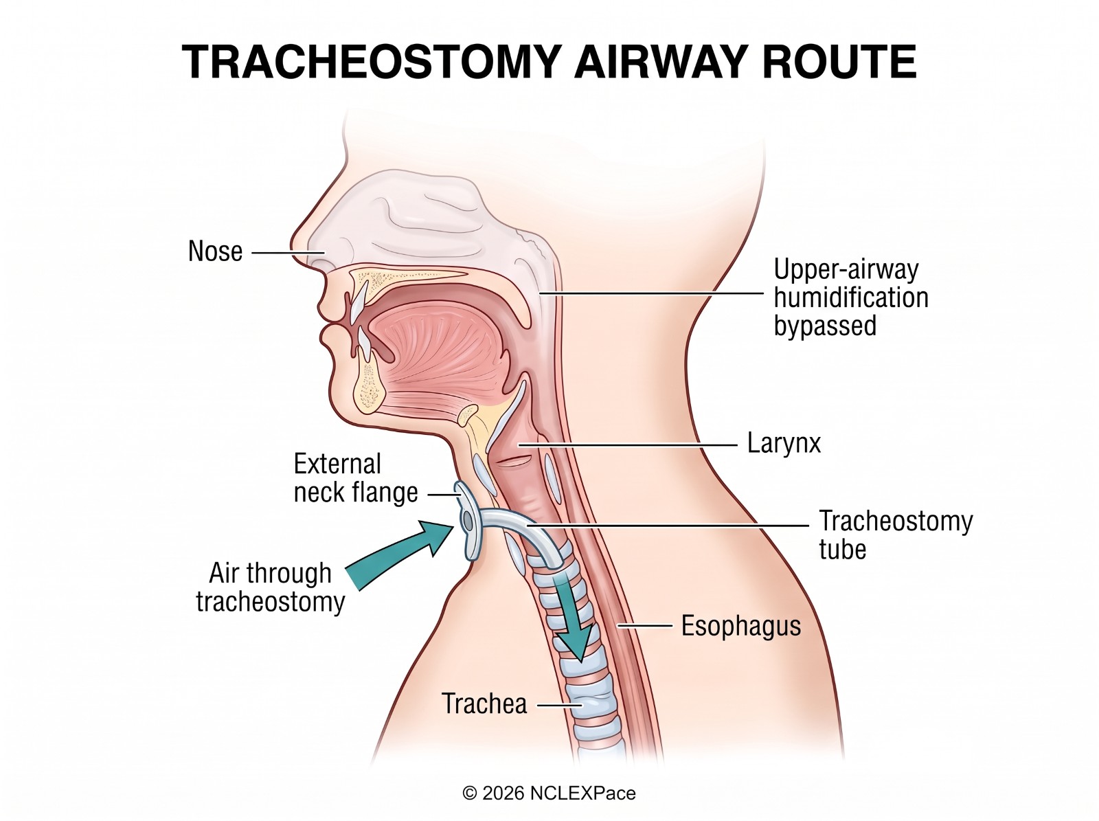 Tracheostomy airway route: air enters through the tracheostomy tube directly into the trachea, bypassing the nose, upper airway humidification and the larynx