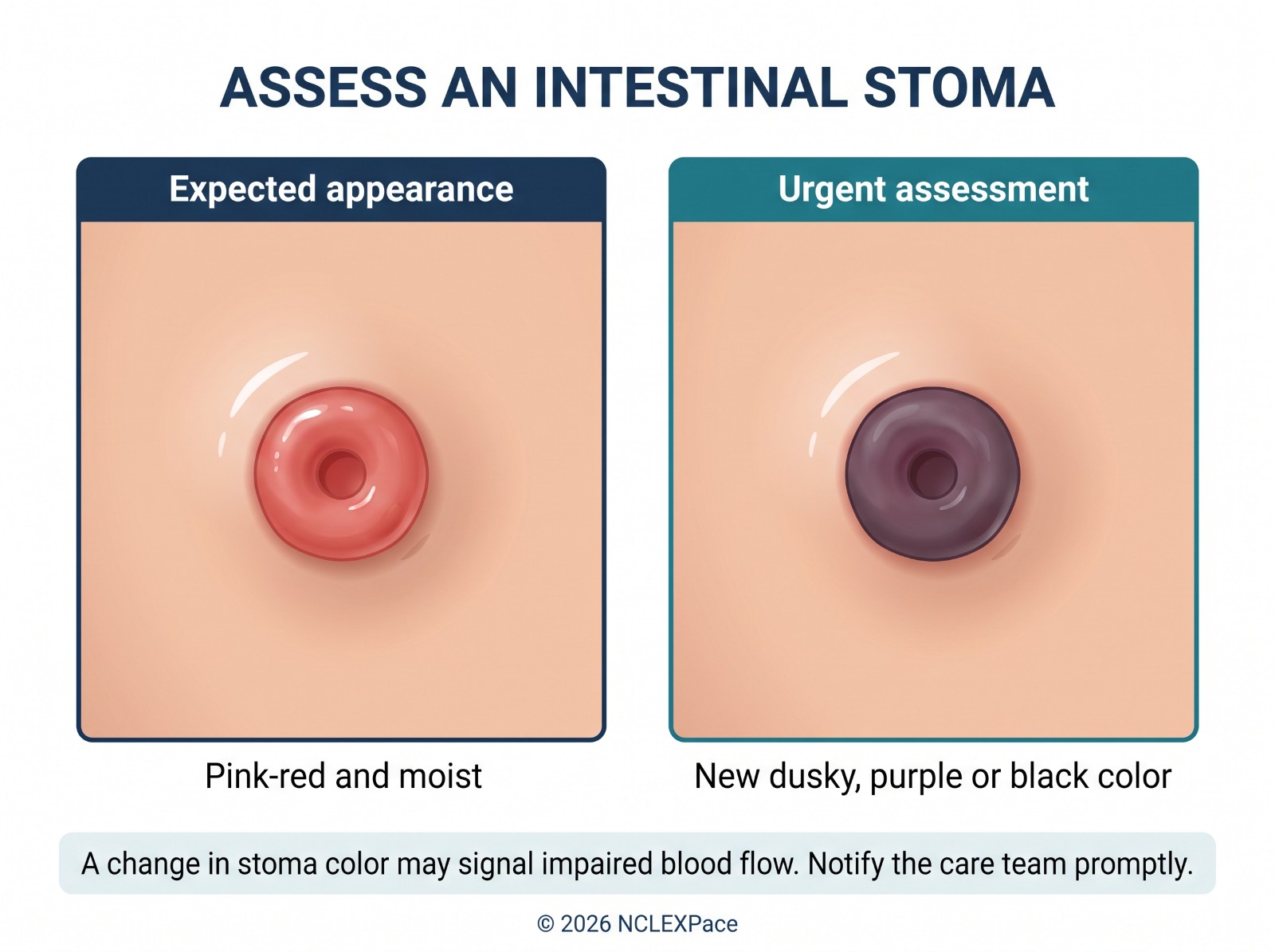 Assessing an intestinal stoma: the expected pink-red moist appearance compared with a new dusky, purple or black stoma that needs urgent assessment
