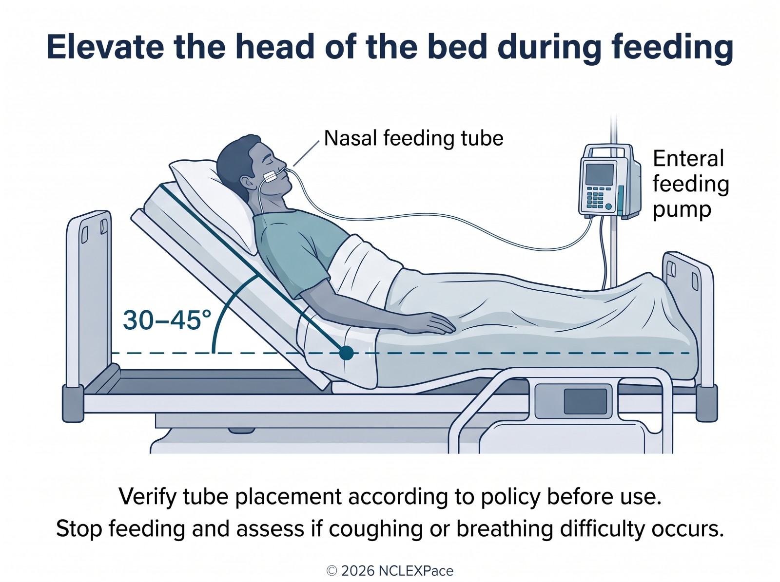 Client receiving an enteral feed through a nasal feeding tube with the head of the bed elevated 30 to 45 degrees