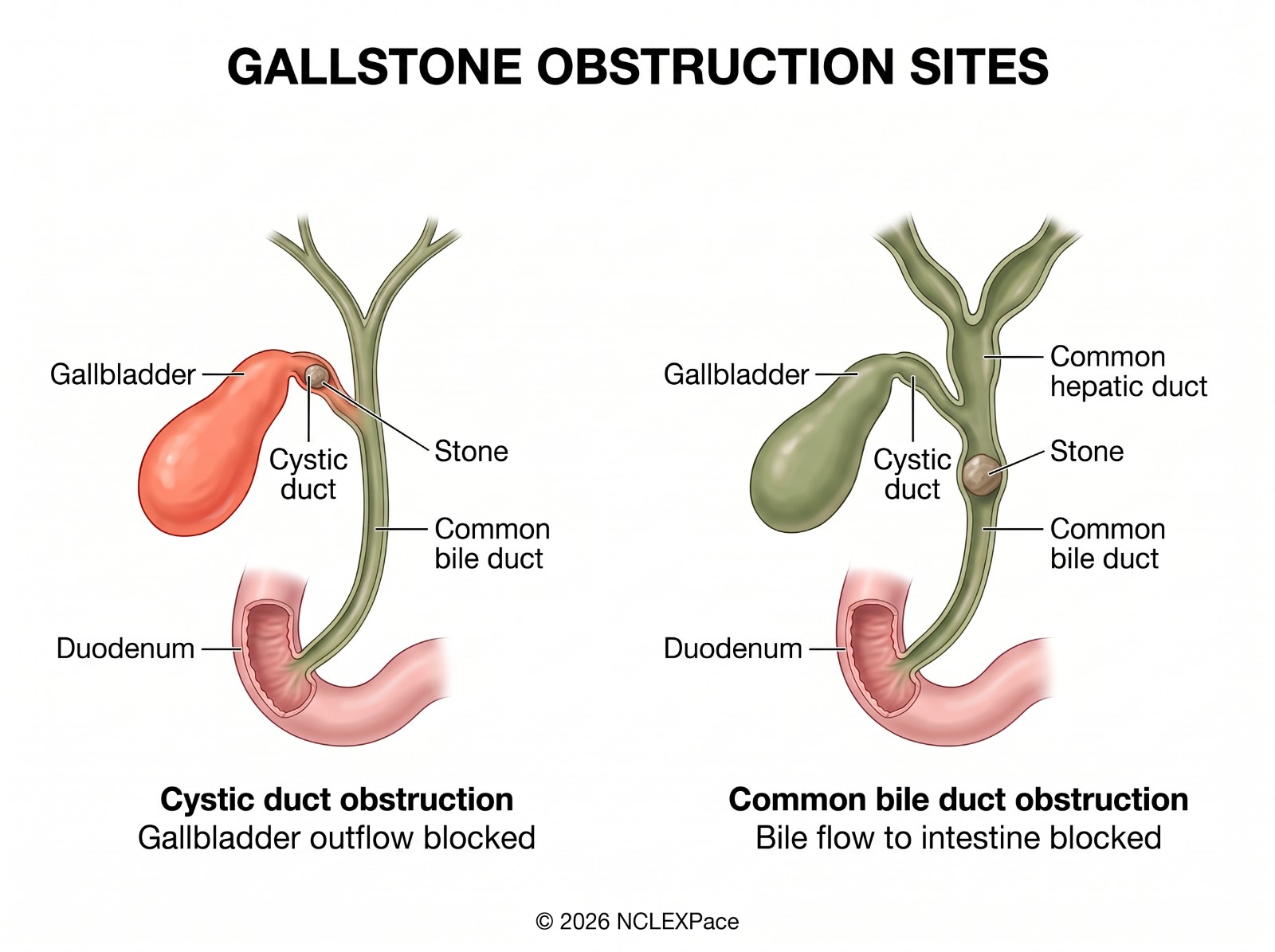 Gallstone obstruction sites: a stone in the cystic duct blocks gallbladder outflow; a stone in the common bile duct blocks bile flow to the intestine