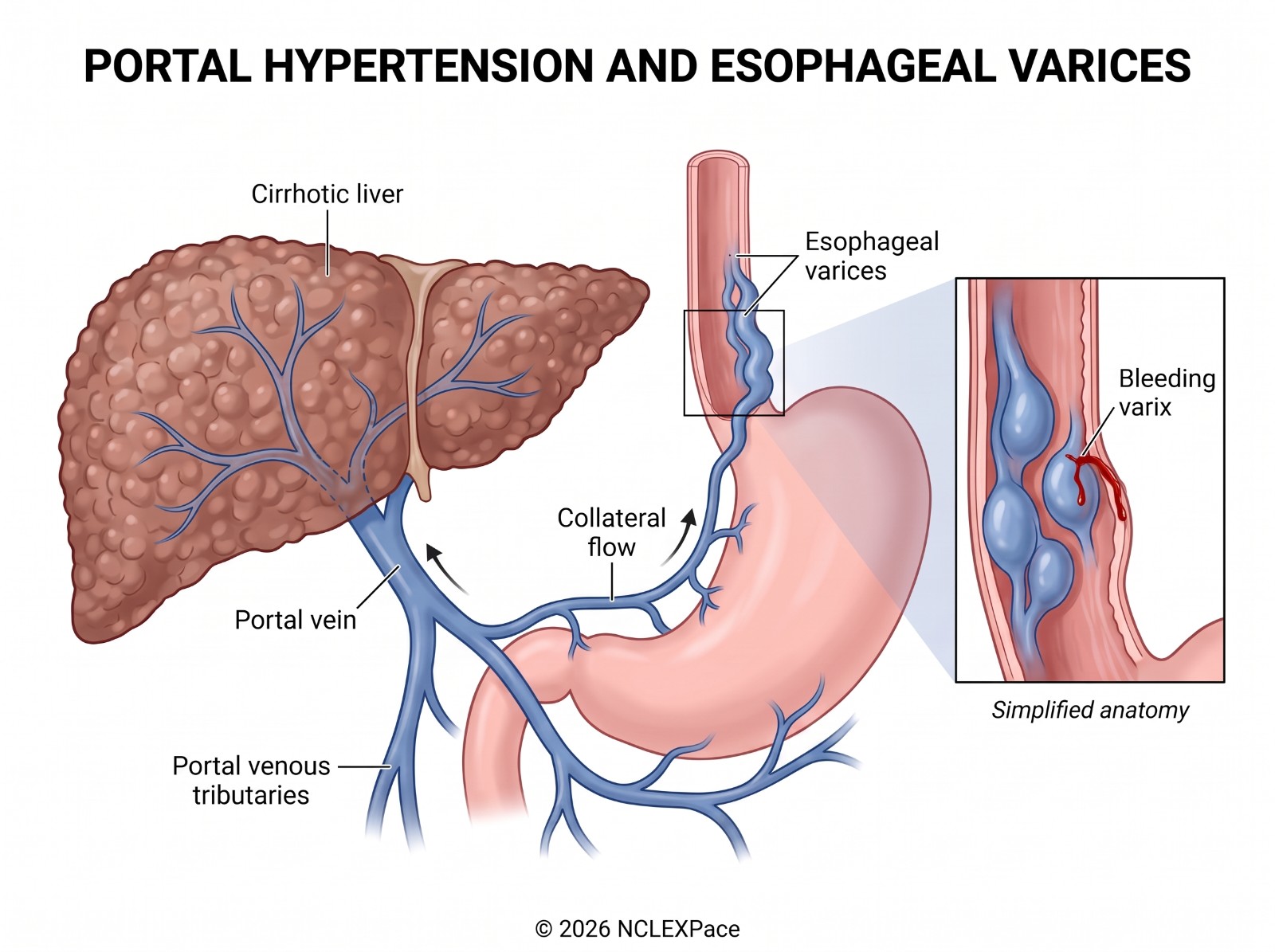 Portal hypertension in cirrhosis: blood backs up from the scarred liver into collateral veins, producing esophageal varices that can bleed