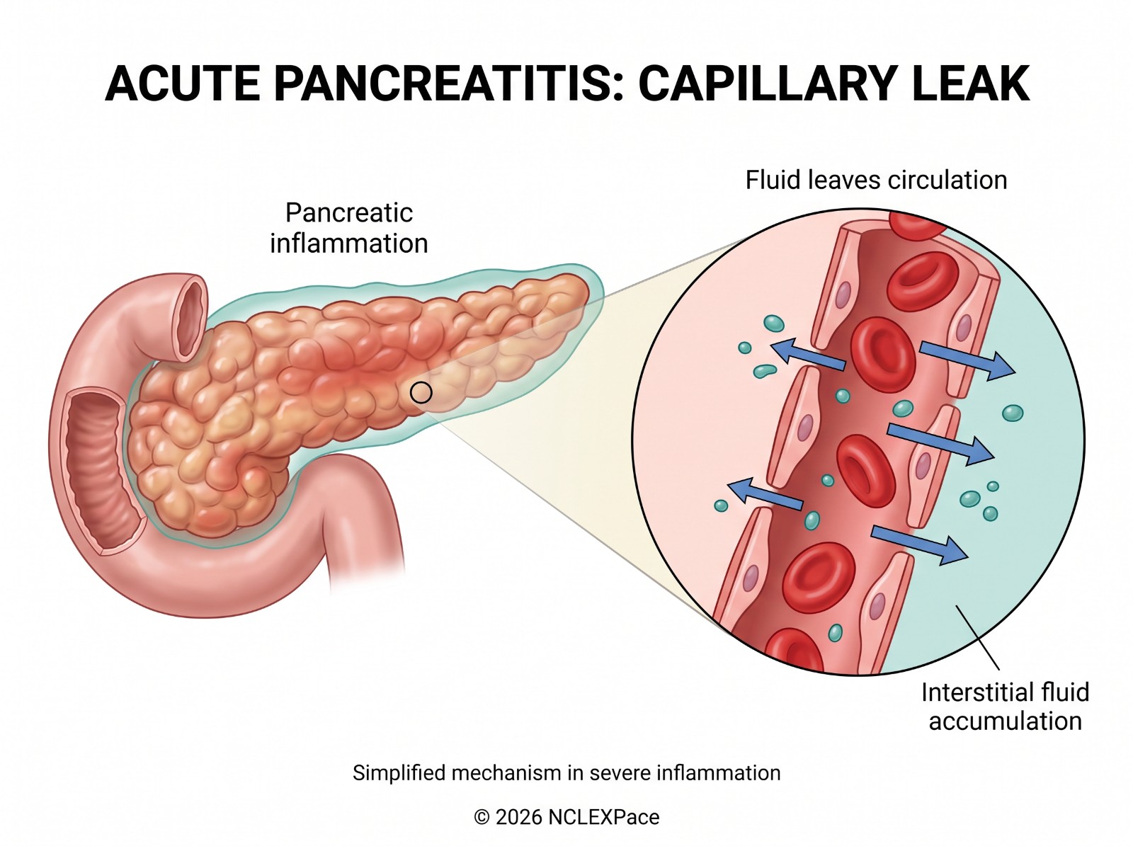 Acute pancreatitis with capillary leak: pancreatic inflammation makes fluid leave the circulation into the interstitial space