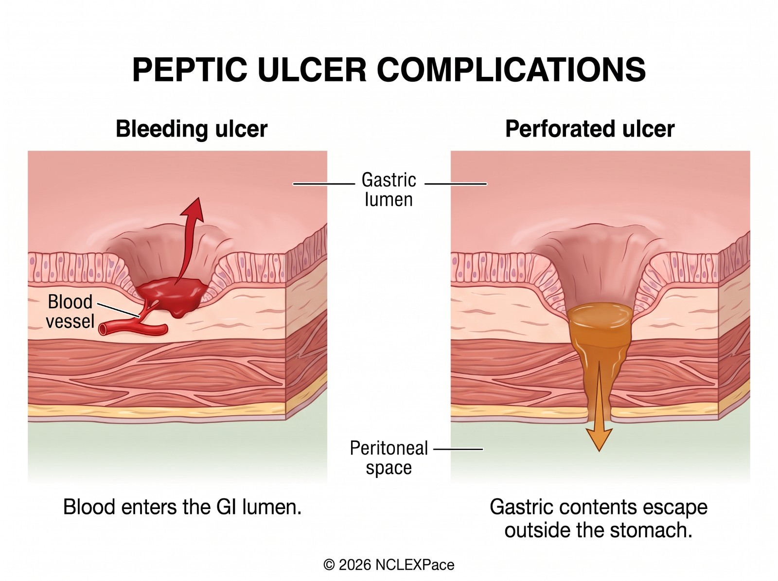 Peptic ulcer complications: a bleeding ulcer with blood entering the gastric lumen, and a perforated ulcer with gastric contents escaping into the peritoneal space