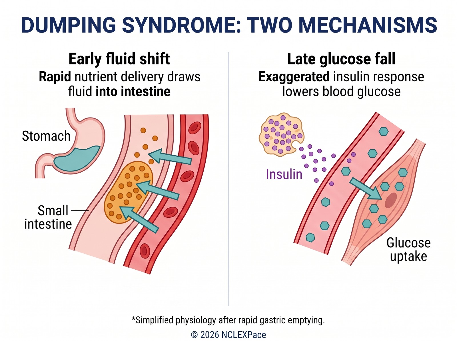 Dumping syndrome, two mechanisms: rapid nutrient delivery draws fluid into the intestine early, then an exaggerated insulin response lowers blood glucose later