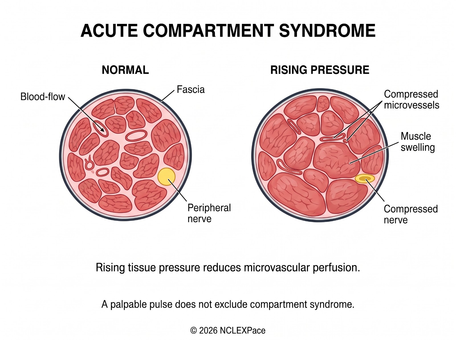 Acute compartment syndrome: normal muscle compartment compared with rising pressure, where swelling compresses the microvessels and the peripheral nerve inside the fascia