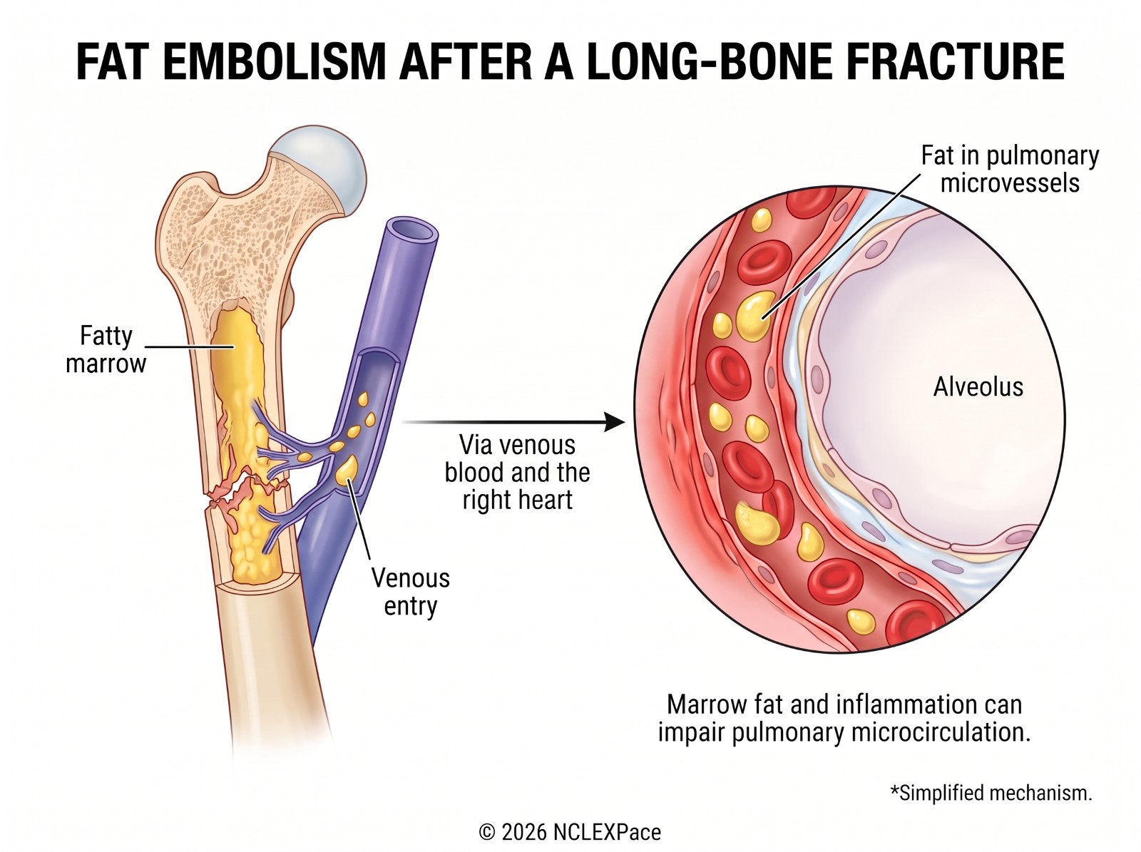 Fat embolism after a long-bone fracture: marrow fat enters the venous blood, travels through the right heart and lodges in the pulmonary microcirculation