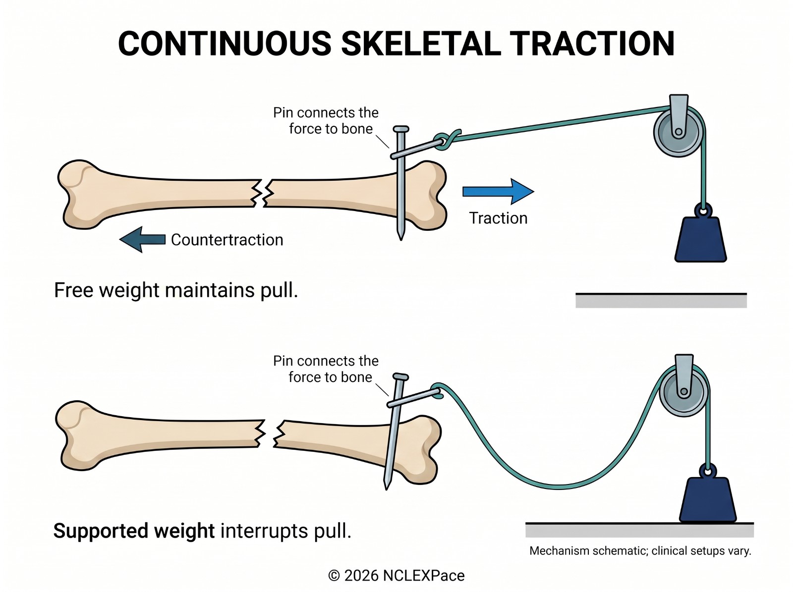 Continuous skeletal traction: a pin through the bone connects to a rope and a free-hanging weight; a supported weight interrupts the pull