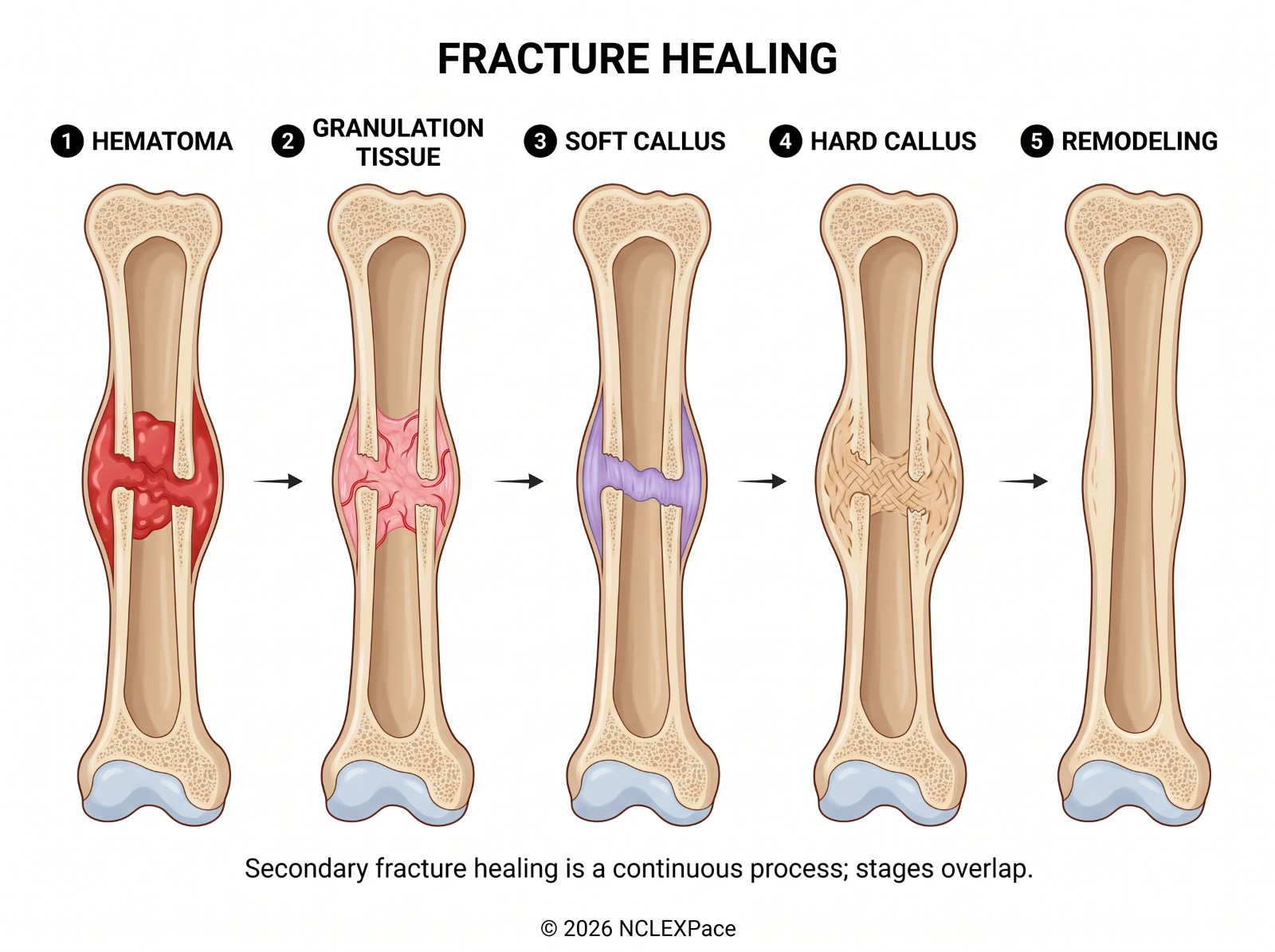 Fracture healing in five stages: hematoma, granulation tissue, soft callus, hard callus and remodeling