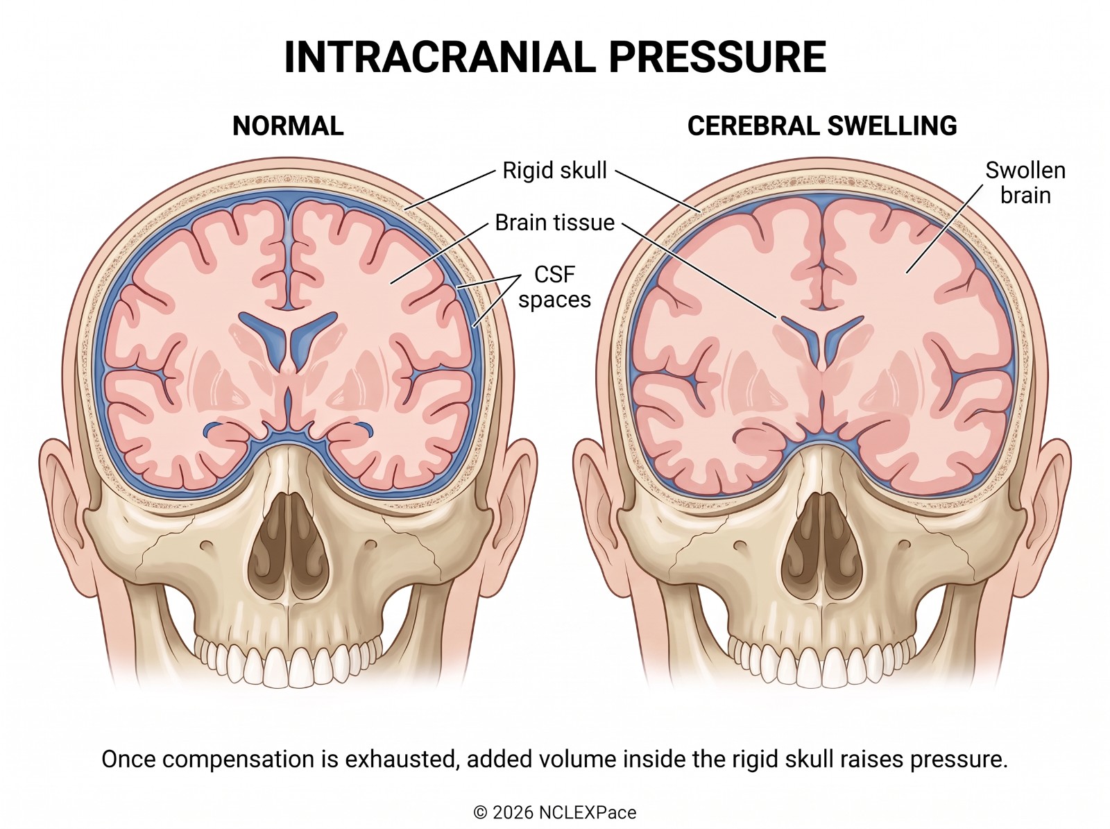 Normal brain inside the rigid skull compared with cerebral swelling, where swollen brain tissue has used up the cerebrospinal fluid spaces