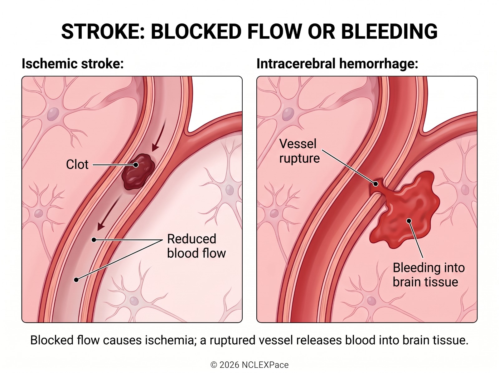 Ischemic stroke with a clot reducing blood flow in a brain artery compared with intracerebral hemorrhage where a ruptured vessel bleeds into brain tissue