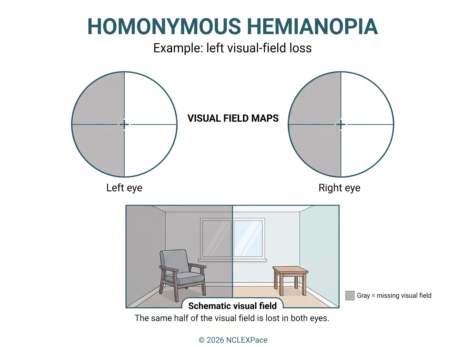 Homonymous hemianopia: the same half of the visual field is lost in both eyes, shown with visual field maps and a room where the left side is missing