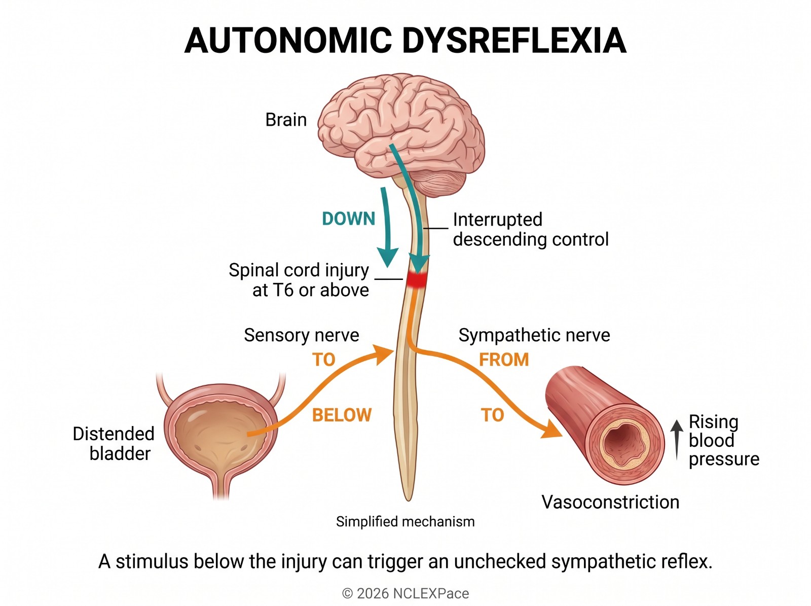 Autonomic dysreflexia: a distended bladder below a T6 spinal cord injury triggers an unchecked sympathetic reflex with vasoconstriction and rising blood pressure