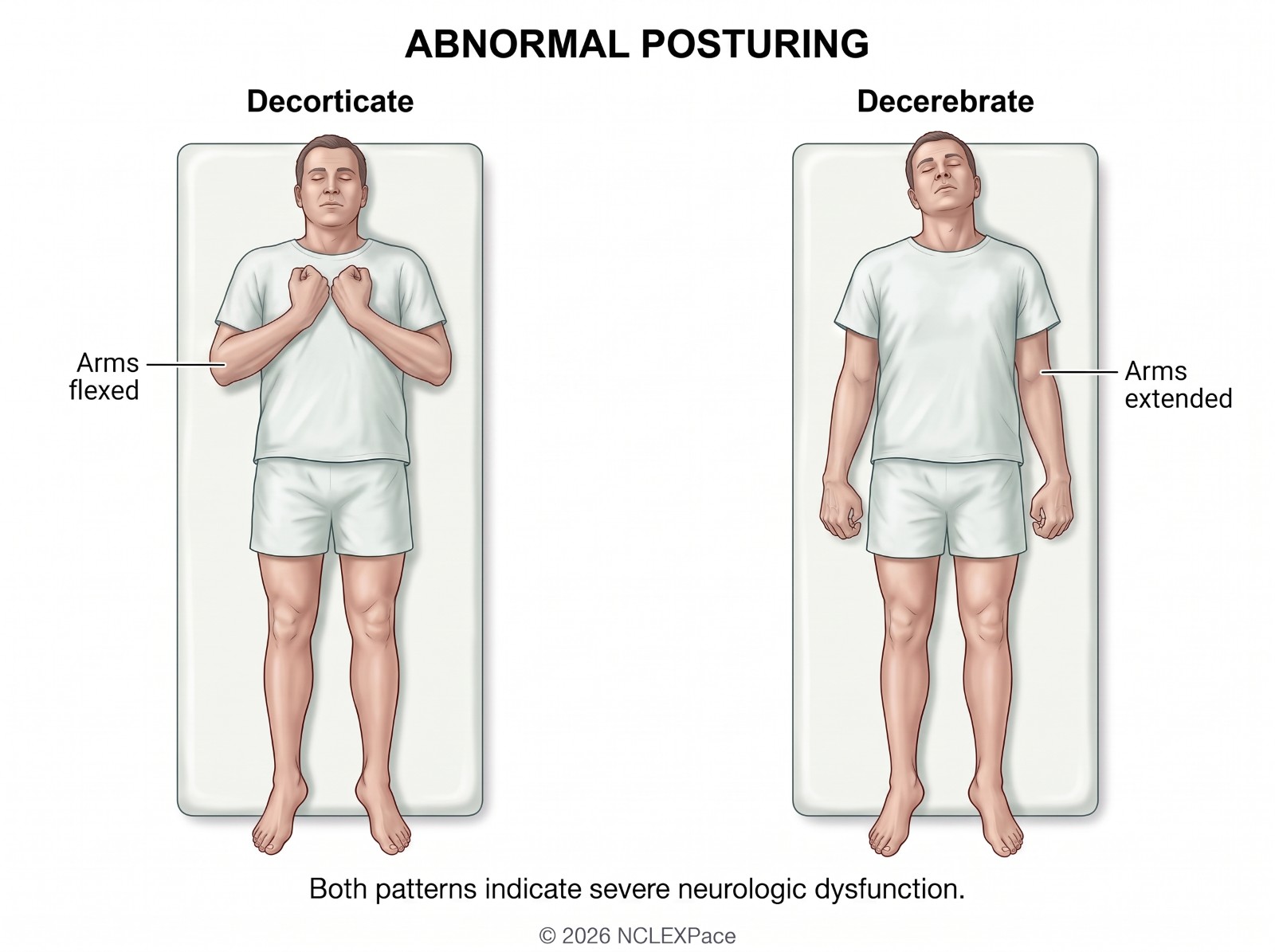 Abnormal posturing: decorticate posturing with the arms flexed toward the chest and decerebrate posturing with the arms extended and rotated