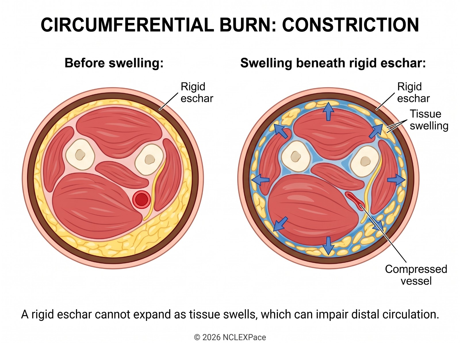 Circumferential burn: rigid eschar around a limb cannot expand, so tissue swelling beneath it compresses the vessels and impairs distal circulation