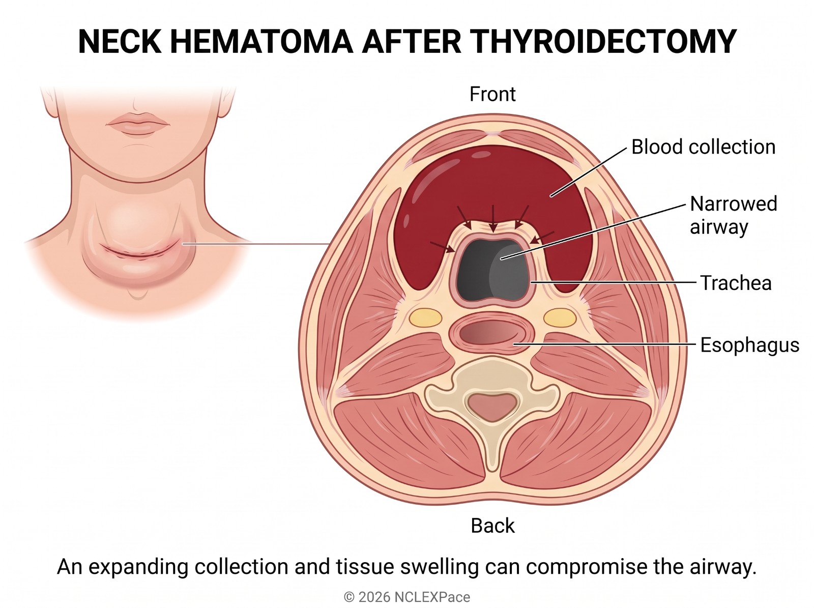Neck hematoma after thyroidectomy: a blood collection in the neck compresses and narrows the trachea