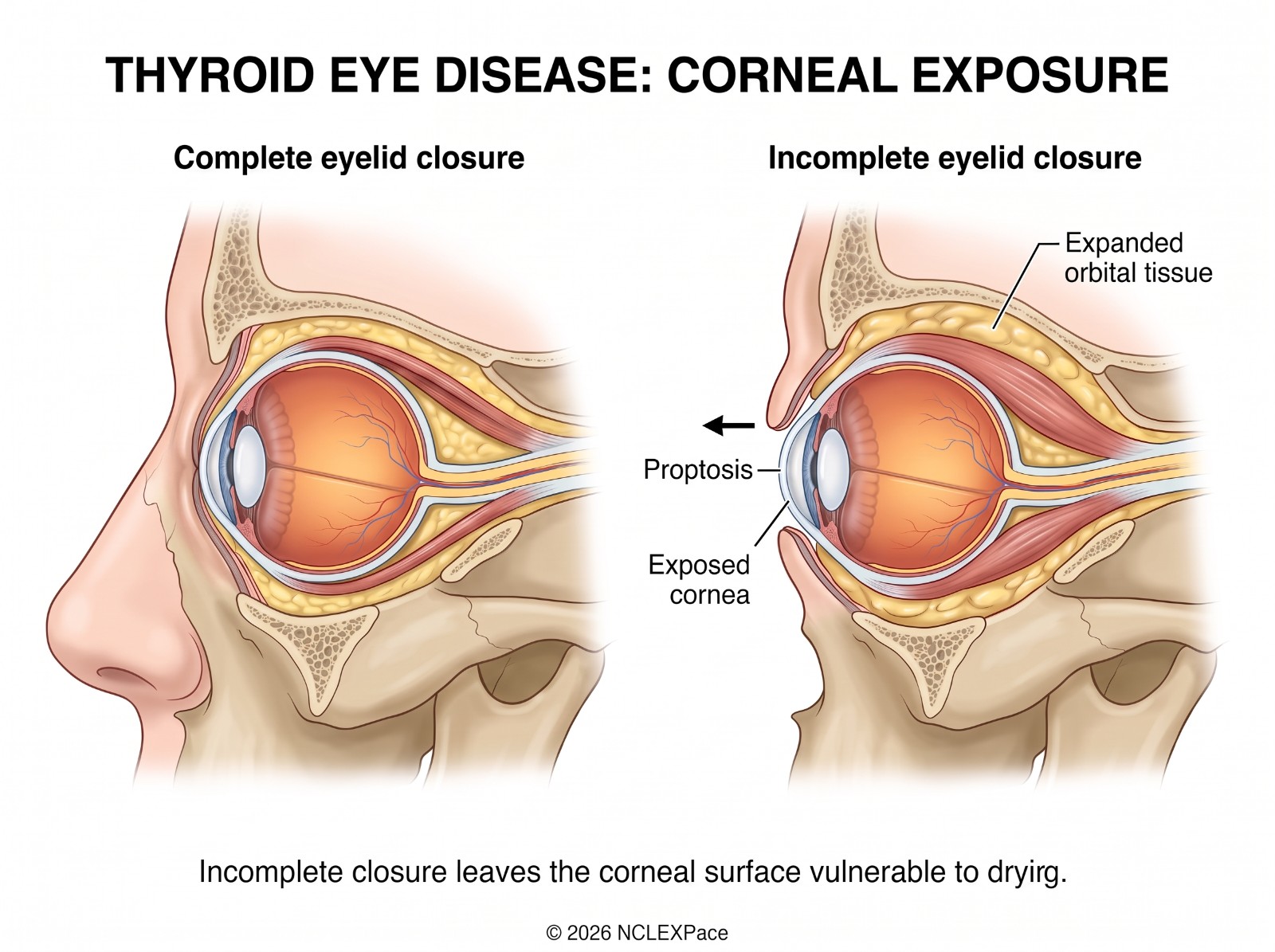 Thyroid eye disease: complete eyelid closure compared with incomplete closure from proptosis, leaving the cornea exposed