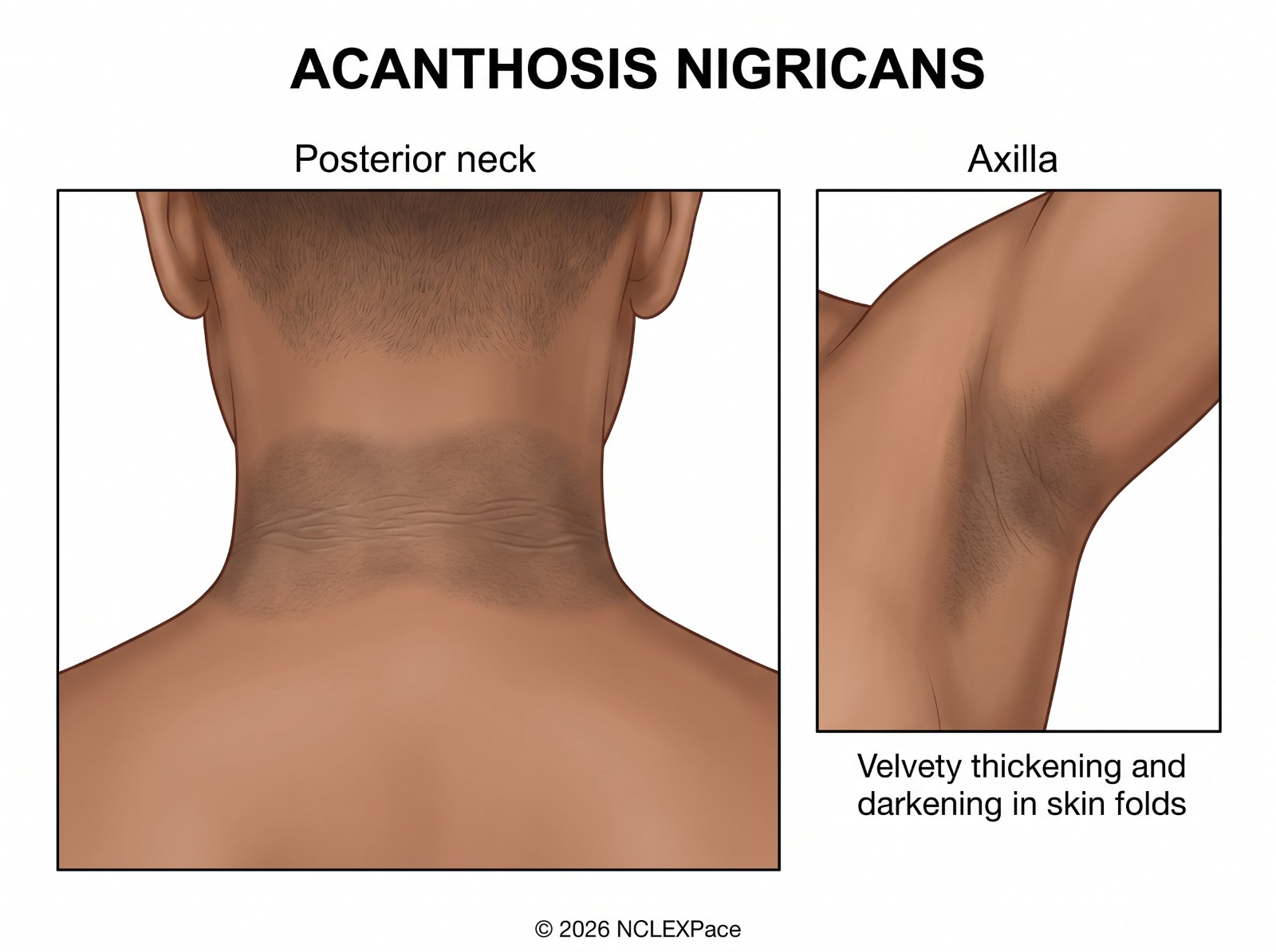 Acanthosis nigricans: velvety thickening and darkening of the skin in the folds of the posterior neck and the axilla