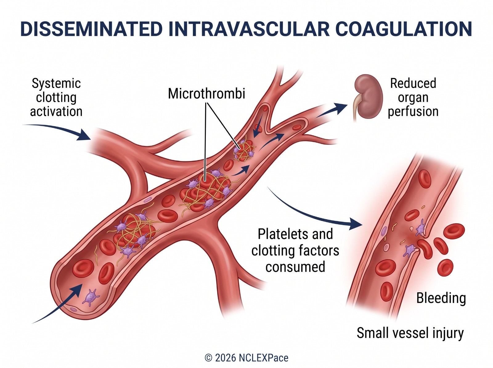 Disseminated intravascular coagulation: systemic clotting activation forms microthrombi that reduce organ perfusion while platelets and clotting factors are consumed, so bleeding follows