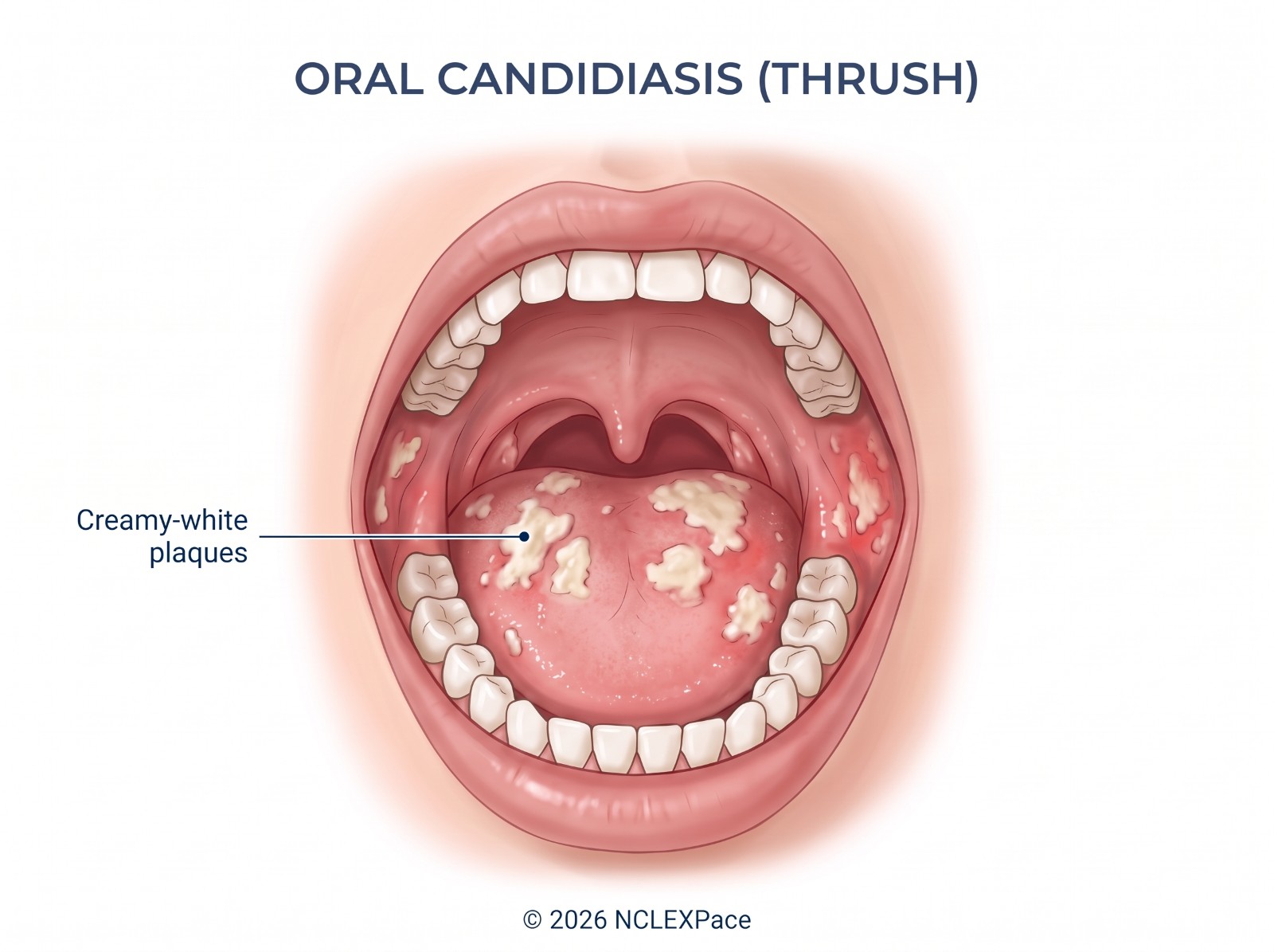 Oral candidiasis: creamy-white plaques on the tongue and inside the mouth
