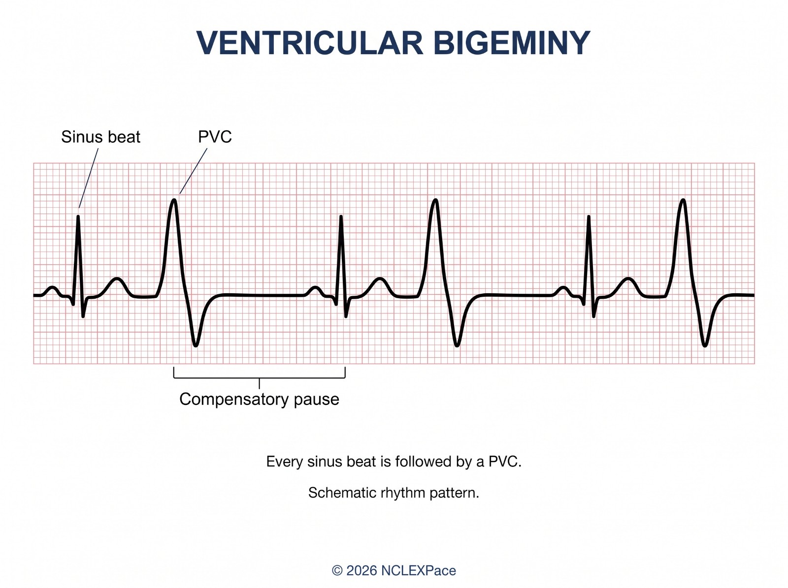 Ventricular bigeminy on a rhythm strip: every sinus beat is followed by a premature ventricular contraction and a compensatory pause