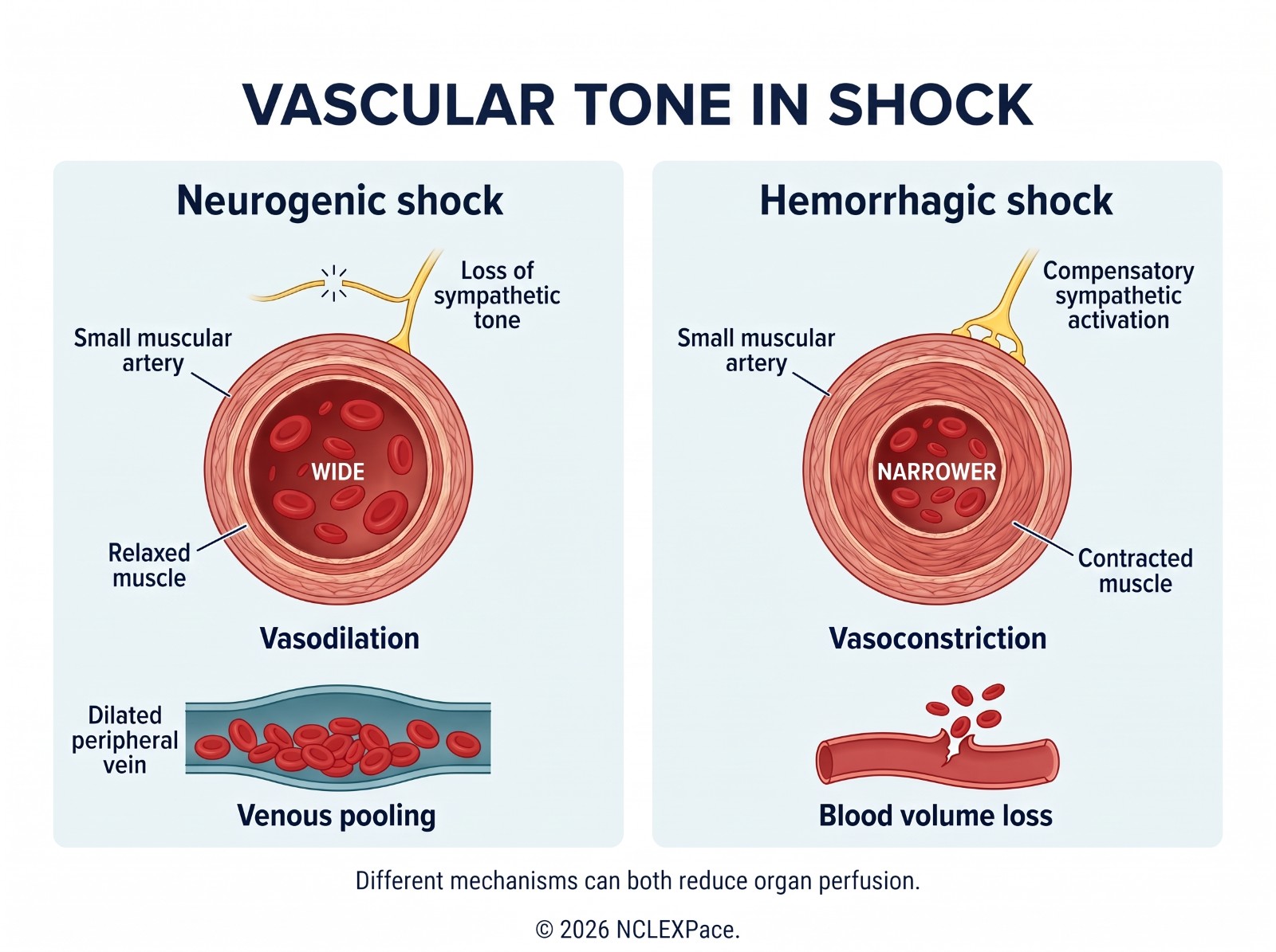 Vascular tone in shock: neurogenic shock with loss of sympathetic tone, vasodilation and venous pooling, compared with hemorrhagic shock with vasoconstriction and blood volume loss