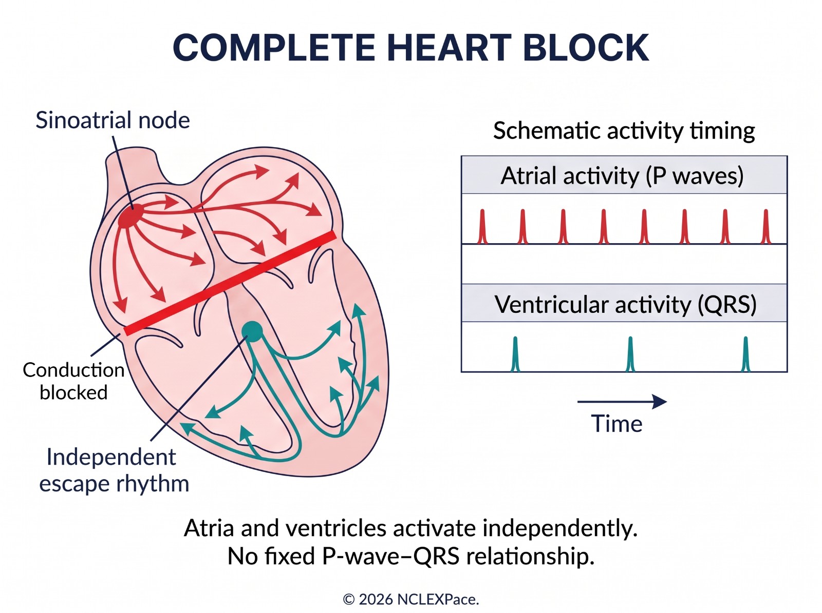 Complete heart block: conduction blocked between the atria and ventricles, which beat independently with no fixed P wave to QRS relationship