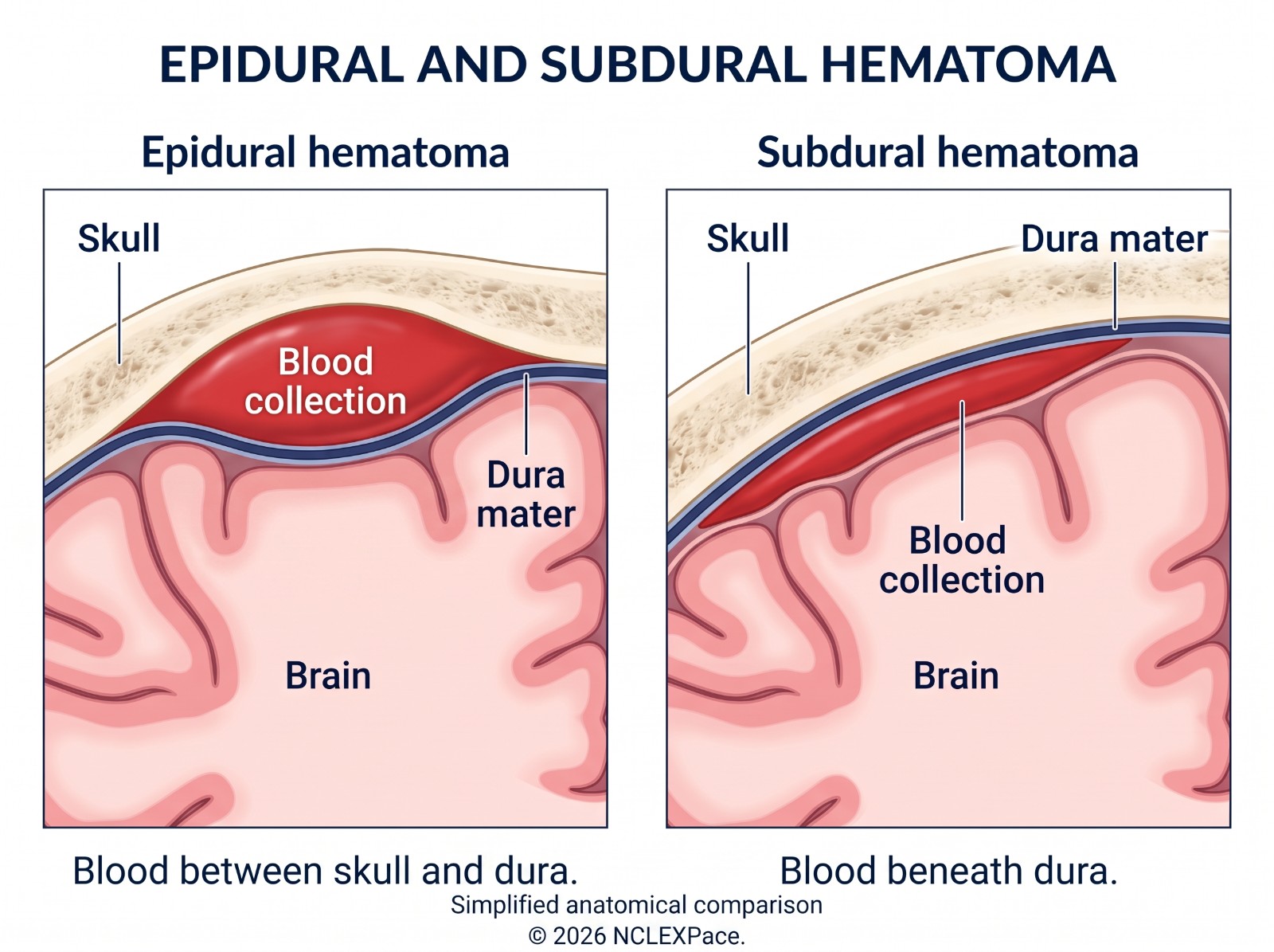 Epidural hematoma with blood between the skull and the dura compared with subdural hematoma with blood beneath the dura