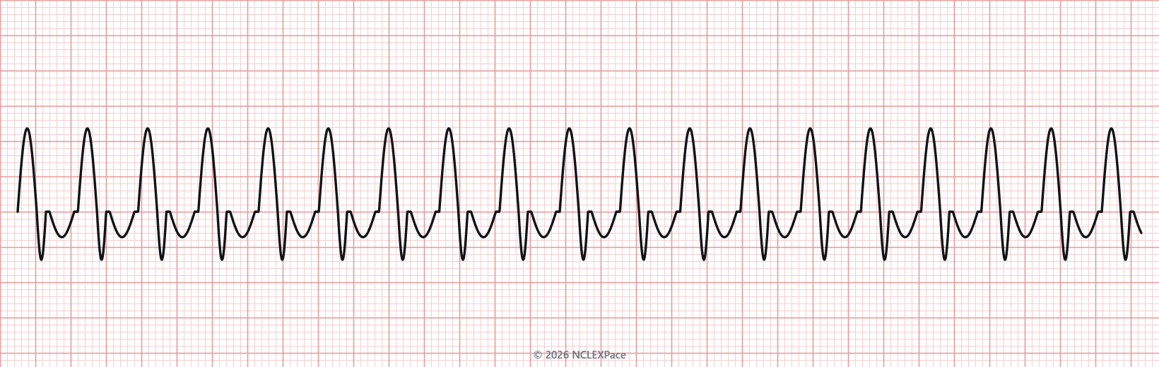Cardiac monitor rhythm strip