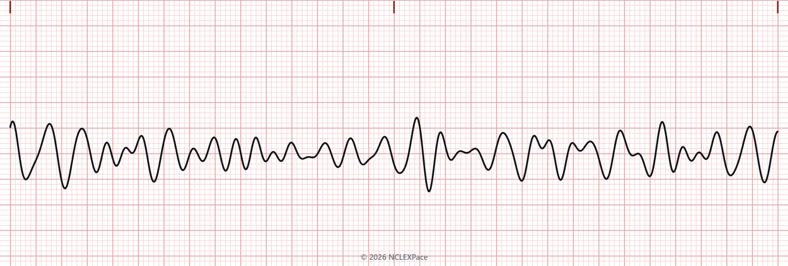 Cardiac monitor rhythm strip
