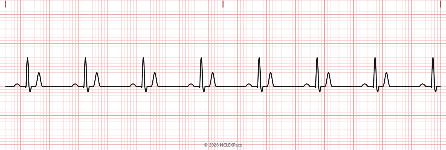 Cardiac monitor rhythm strip